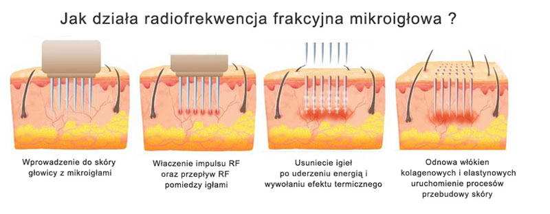 Radiofrekwencja frakcyjna mikroigłowa